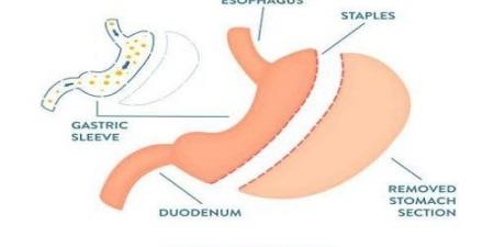 ما هي أضرار عملية تحويل مسار المعدة على المدى البعيد؟ دكتور أسامة خليل - بوابة المساء الاخباري