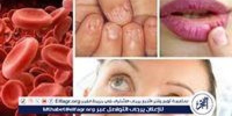 أعراض نقص الحديد في الجسم.. نصائح تساعد في العلاج