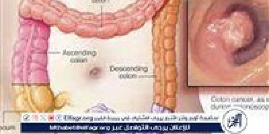 اختبار دم يكشف الإصابة بسرطان القولون