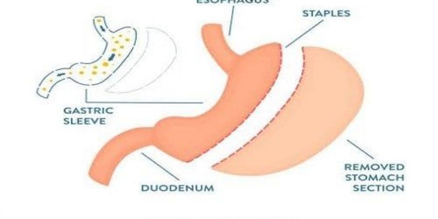 ما هي أضرار عملية تحويل مسار المعدة على المدى البعيد؟ دكتور أسامة خليل - بوابة المساء الاخباري